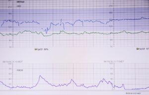 atrial fibrillation guide