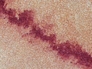 cellulitis when to worry