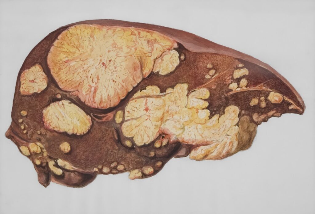 Fatty Liver Disease: MASLD and MASH (formerly NAFLD/NASH) Causes, Symptoms, and Treatment