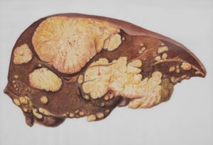 fatty liver disease guide