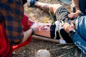 how to treat 2nd degree burn