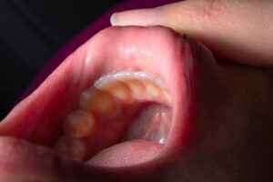 how to treat canker sores