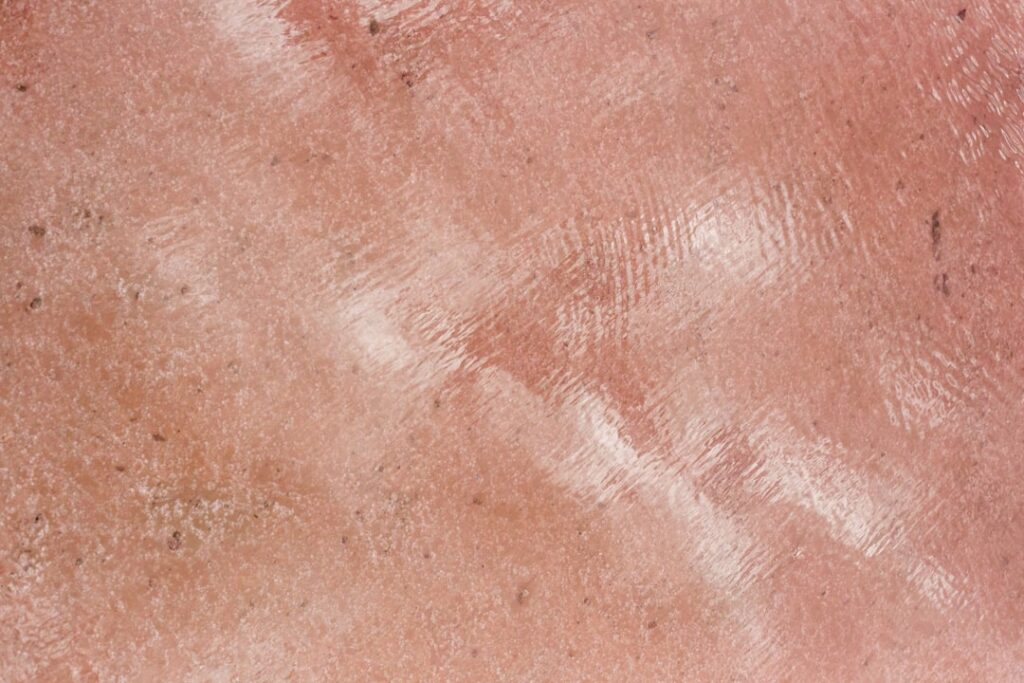 How to Treat Sun Poisoning: Home Remedies and When to See a Doctor