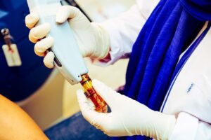 laser treatment acne scars