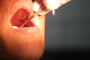 symptoms of oral cancer