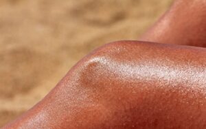 symptoms of sun poisoning