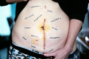 tummy tuck recovery timeline