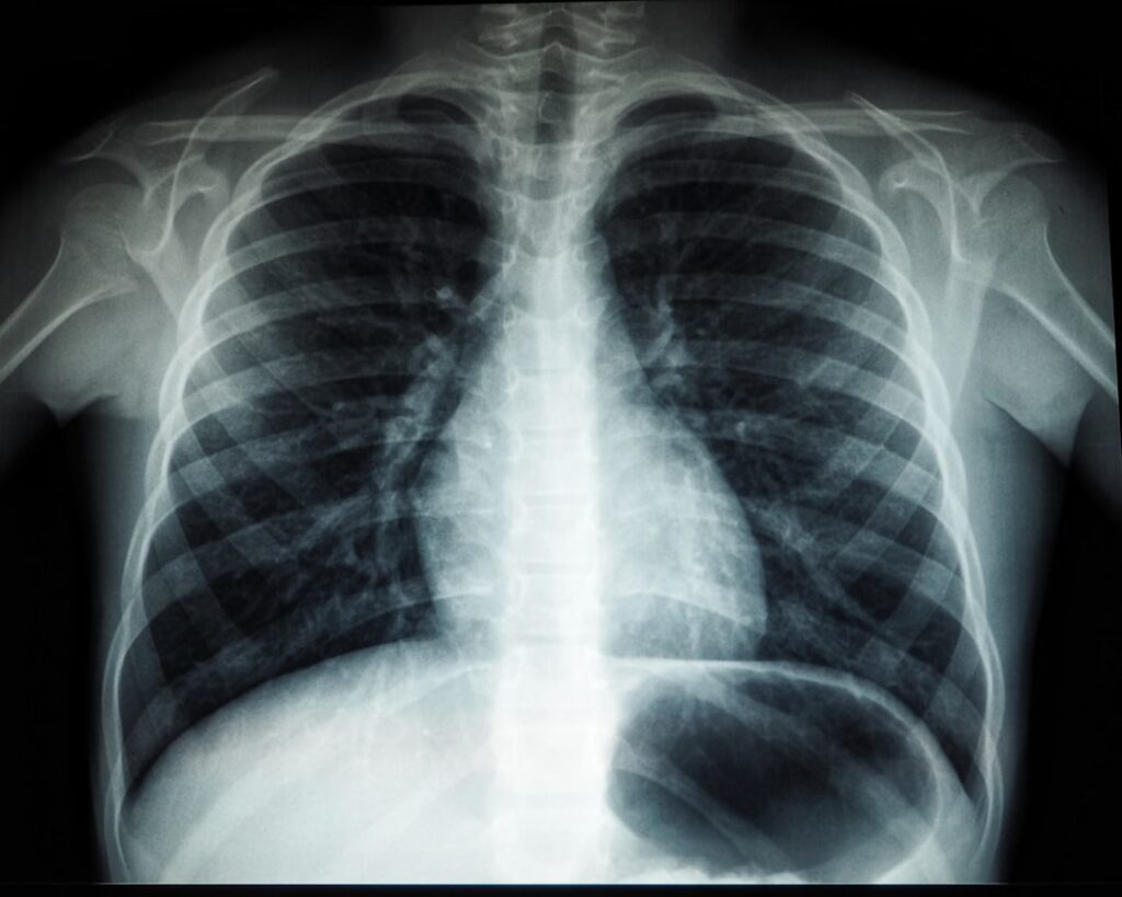 When to Worry About Lung Nodules: Size, Risk, and Next Steps