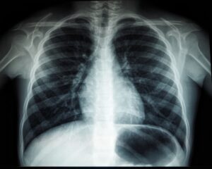 when to worry about lung nodules