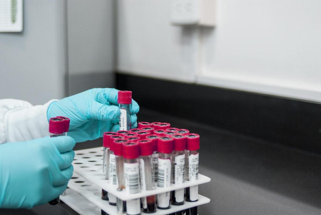 Iron and TIBC Tests: Iron Studies Explained