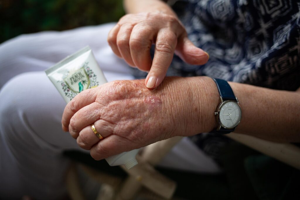 Naproxen vs Ibuprofen for Arthritis: Which Works Better?